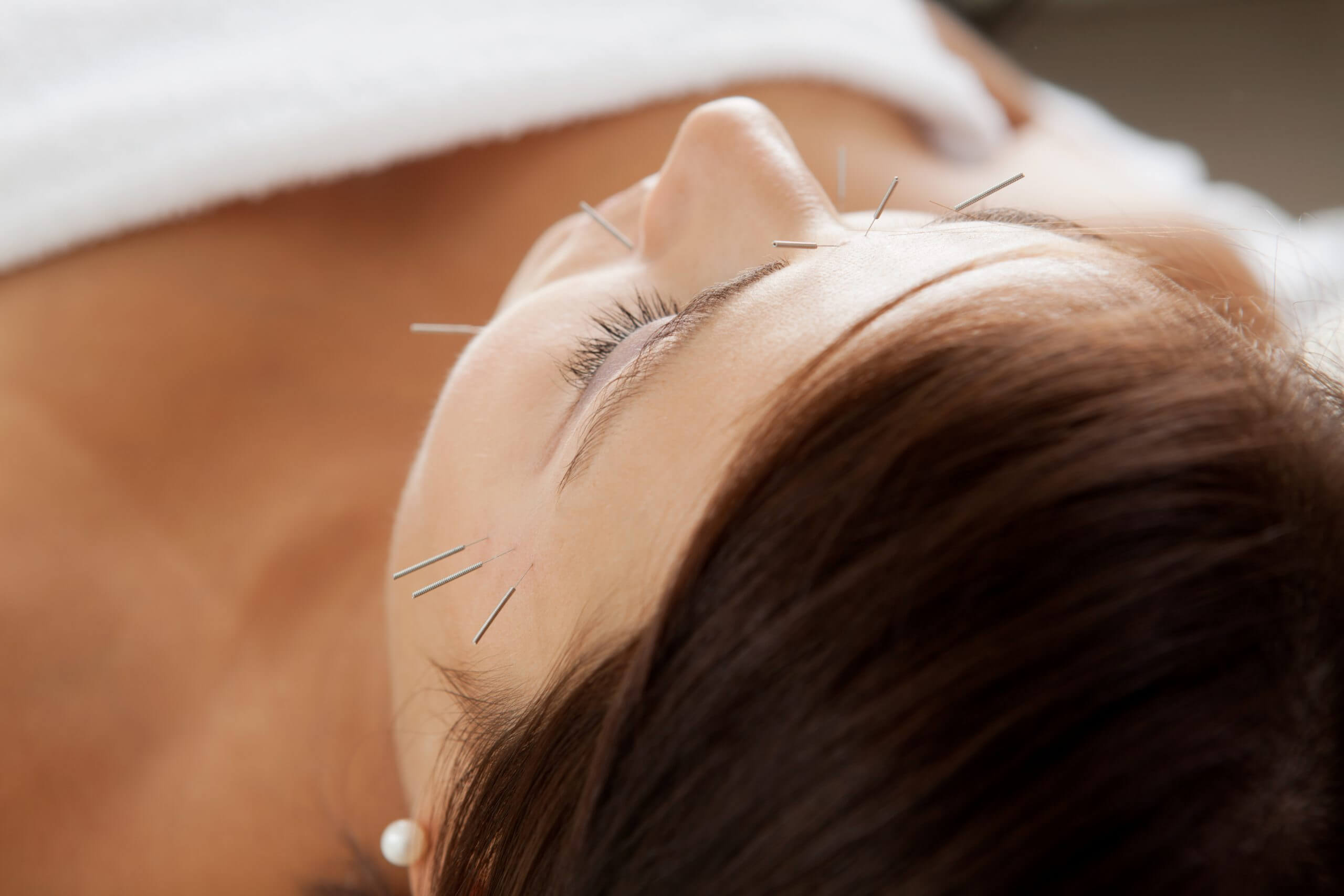 Better than botox - Cosmetic Acupuncture Procedure