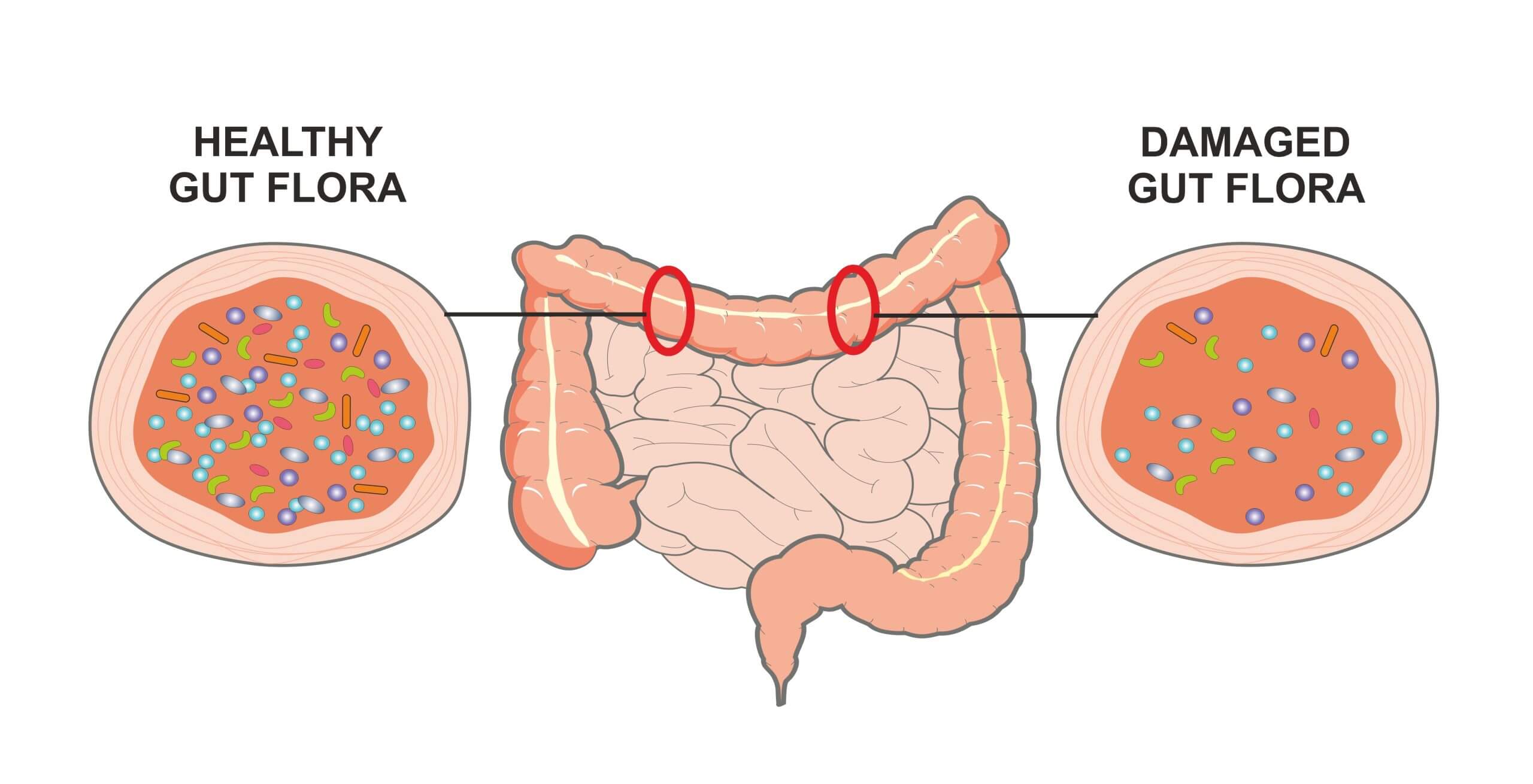 Image of intestines with cross sections comparing healthy gut flora with unhealthy gut flora.